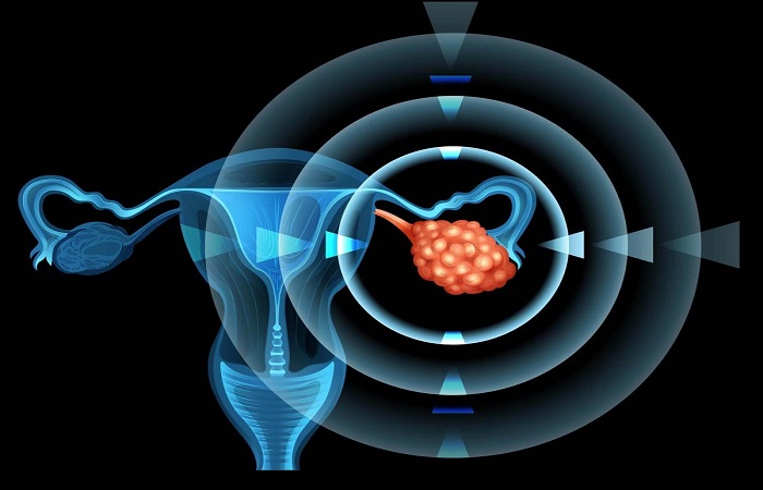 Causes of ovarian cancer