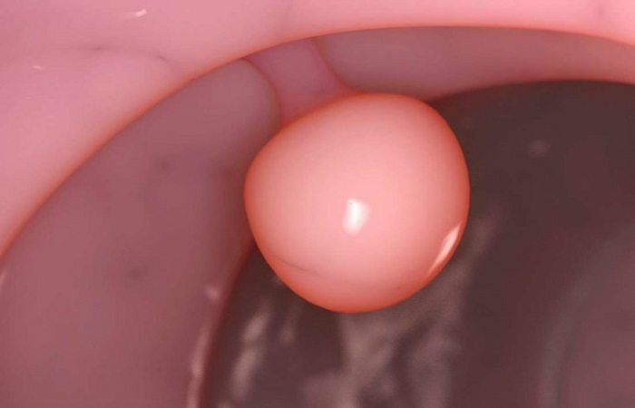 Cervical polypse