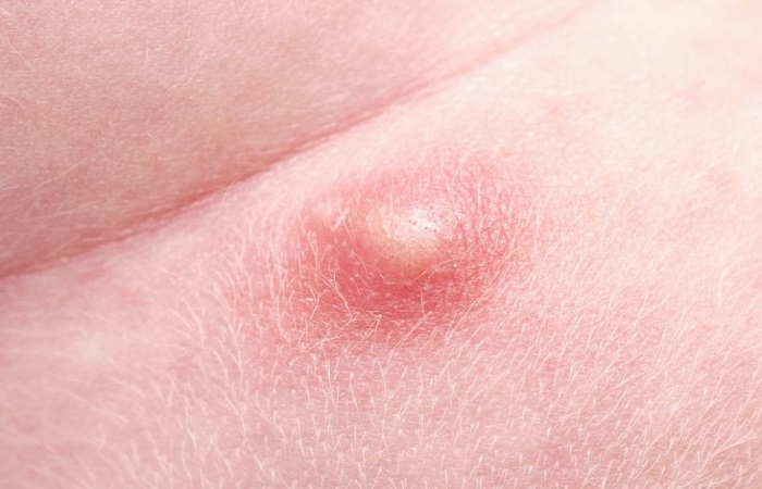 Pimples on the genital lips that hurt