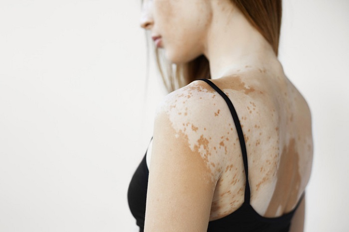 White spots on the vulva from vitiligo